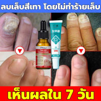 ?7วัน ซ่อมแซมเล็บเสียอย่างรวดเร็ว?เล็บเชื้อรา 30ml แก้เชื้อราที่เล็บ บำรุงเล็บ ลากับเล็บเสีย ไม่ทำร้ายเล็บดี ห่างกับปัญหาเล็บ เซรั่มซ่อมแซมเล็บ เซรั่มบำรุงเล็บ ยาใส่เล็บขบ ครีมบำรุงเล็บ ยาบำรุงเล็บ เชื้อราเล็บมือ