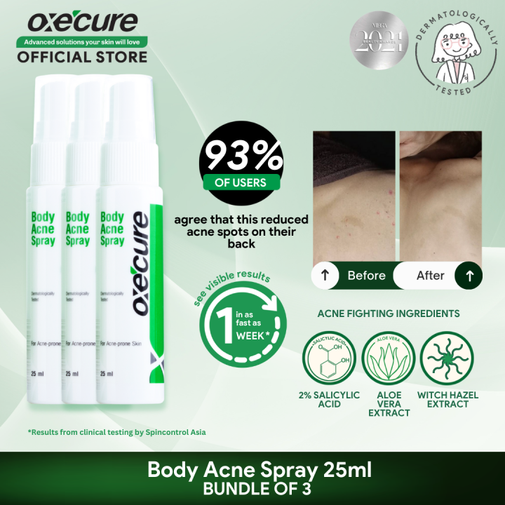 OXECURE Body Acne Spray 25ml, Bundle of 3 Lazada PH