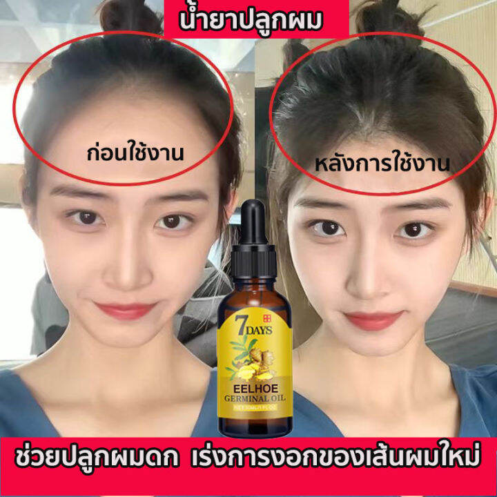 ได้ผลดีมาก-หมดปัญหาผมร่วง-eelhoe-น้ำยาปลูกผม-40ml-เร่งการงอกใหม่-ป้องกันไม่ให้ขิงหลุด-รากผมแข็งแรง-ดูแลหนังศีรษะ-ยาปลูกผมของแท้-เซรั่มบำรุงผม-เซรั่มปลูกผม-น้ำยาเร่งผมยาว-ซรั่มปลูกผม-ยาปลูกผมผู้ชาย