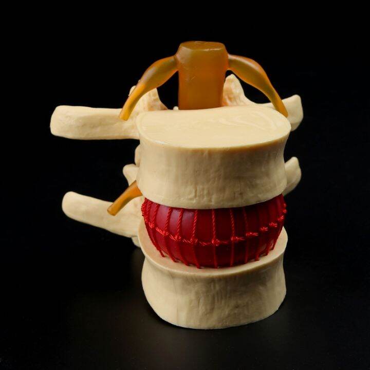 medical-props-model-free-postage-anatomical-spine-lumbar-disc-herniation-anatomy-medical-teaching-tool