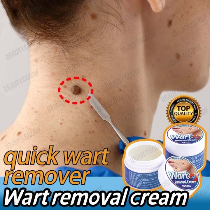 Warts Remover Original Cream Kasoy Oil Cream Kulugo Mole Skin Tag Wart Remover Wart Removal 7039