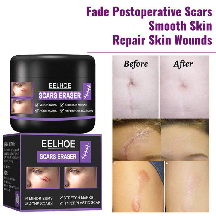 Scar Remover 50g Can Acne Scar Remover Surgery Scar Insect Bites Mark Acne Spots Keloid Scar