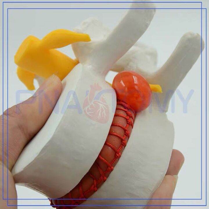 model-of-lumbar-intervertebral-disc-human-intervertebral-disc-extrusion-spine-vertebra-bone-anatomy-medical-teaching-demonstration-teaching-aids