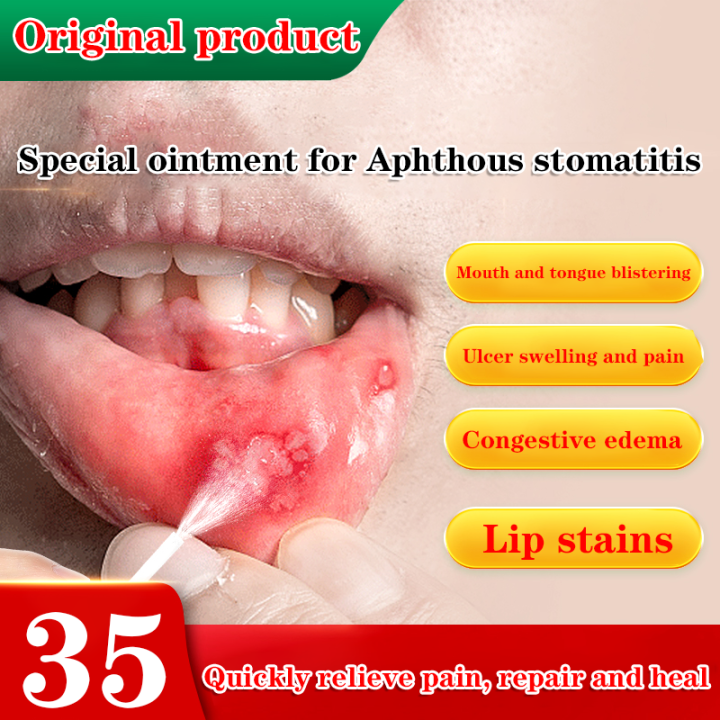 Aphthous stomatitis special mouth ulcer gel special effect