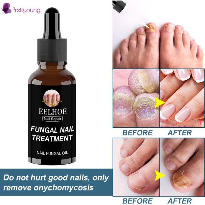Prettyoung Eelhoe 50ML Nail Repair Essence Serum Nail Fungus Treatment