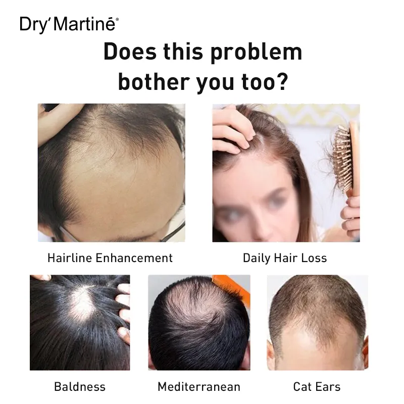 Herber Hair Fall Treatment Hair Loss Anti Hair Loss Spray Prevent Hair Loss  and Thinning for Men & Women 100% Natural Formula No Side Effects 120ml |  Lazada PH