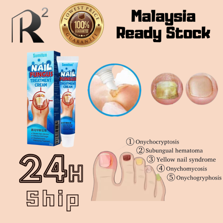 Sumifun 20g Nail Fungus Removal Cream Nail Onychomycosis Paronychia