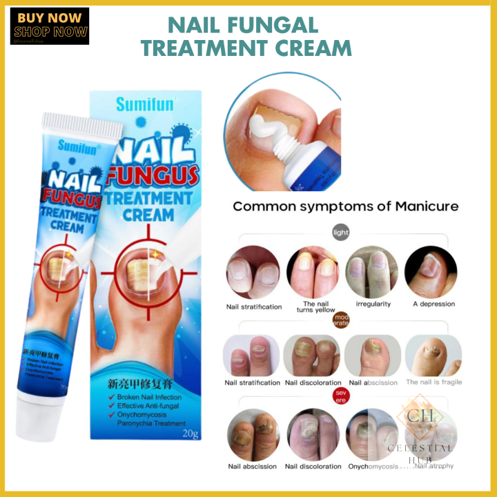 Effective In 5 Days - Sumifun Nail Fungus Repair Treatment Foot Care ...