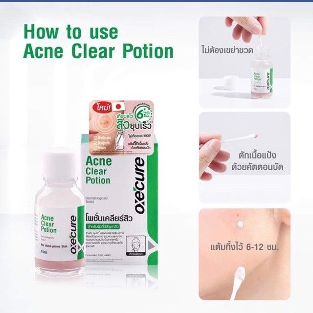 oxe-cure-acne-clear-potion-15ml-อ๊อกซีเคียว-แอคเน่-เคลียร์-โพชั่น-แต้มสิว-สิวอักเสบ-ลดรอยดำ-ไม่ระคายเคือง