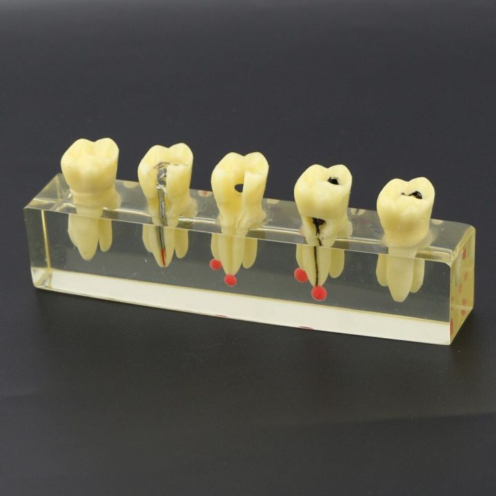 dental-endodontic-treatment-demonstration-model-4012-study-teach-teeth-model