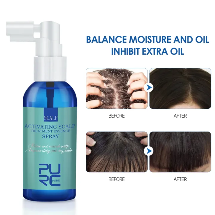 Hair Scalp Treatment Anti Dandruff Anti Itch Essence Spray Prevent Hair