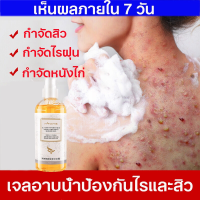 ครีมอาบน้ำลดสิว เจลอาบน้ำไวท์เทนนิ่งผิว 260ml จัดการสิวแห้งผิวคันต่อต้านเชื้อราลดกลิ่นอย่างมีประสิทธิภาพ