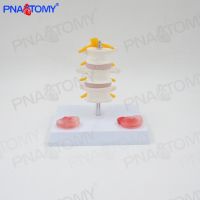 Human body three lumbar intervertebral disc with spinal nerve lesions skeleton model orthopedic medical teaching pain bonesetting