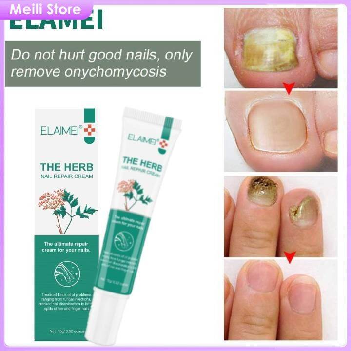 Meili Store ELAIMEI Nail Fungus Treatment Cream, Nail Repair Cream