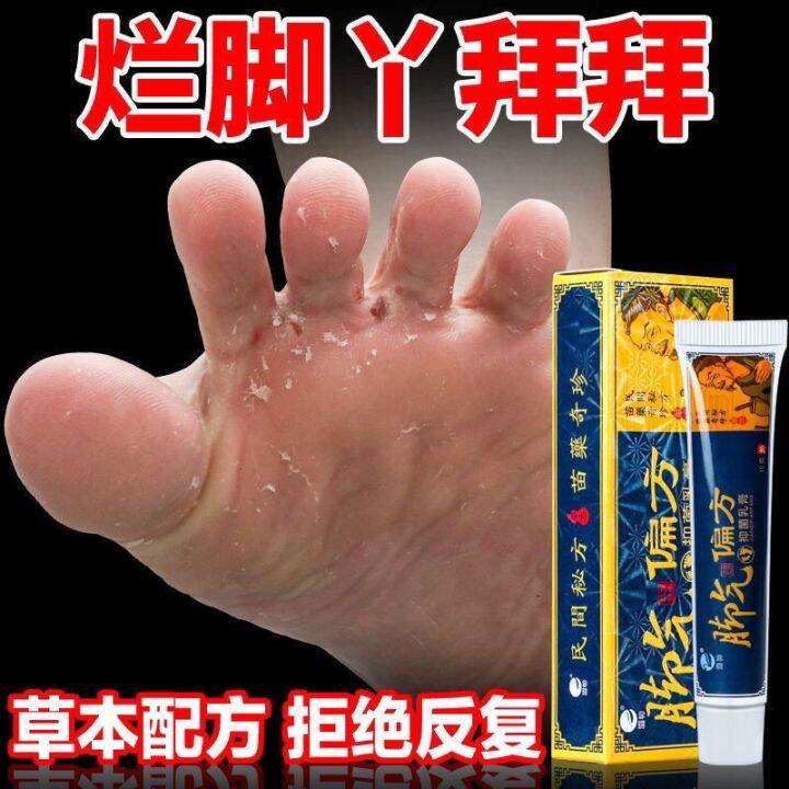 Athlete's Foot Cream Anti Fungal Anti Bacterial Cream Effective for