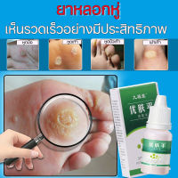 wart removal liquid เอสเซ้นลอกหูด 10ml ยาแต้มหูด ลอกหูดตาปลา  ขจัดติ่งเนื้อ เอสเซ้นลอกหูด ไม่ทิ้งร่องรอยป ครีมกําจัดไฝหูดติ่งเ หูดตาปลาและติ่งเนื้อ