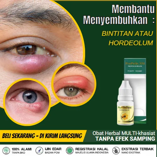 Obat Bintitan Atau Hordeolum Bintil Sakit - Jerawat Atau Bisul Tumbuh ...