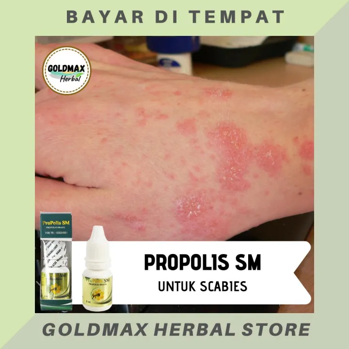 Obat Scabies Alami - Obat Scabies Herbal, Obat Scabies Minum, Obat ...