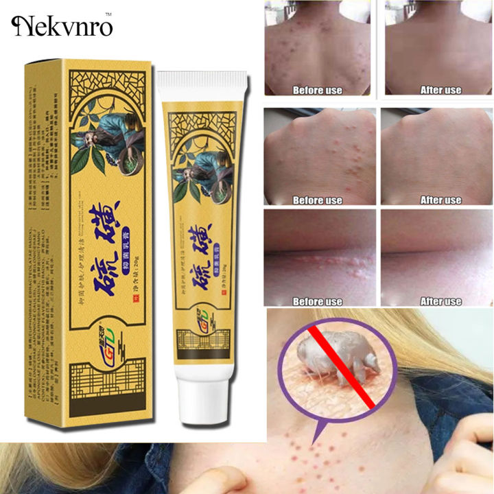 Nekvnro Scabies Ointment Antibacterial Cream Scabies Treatment for ...
