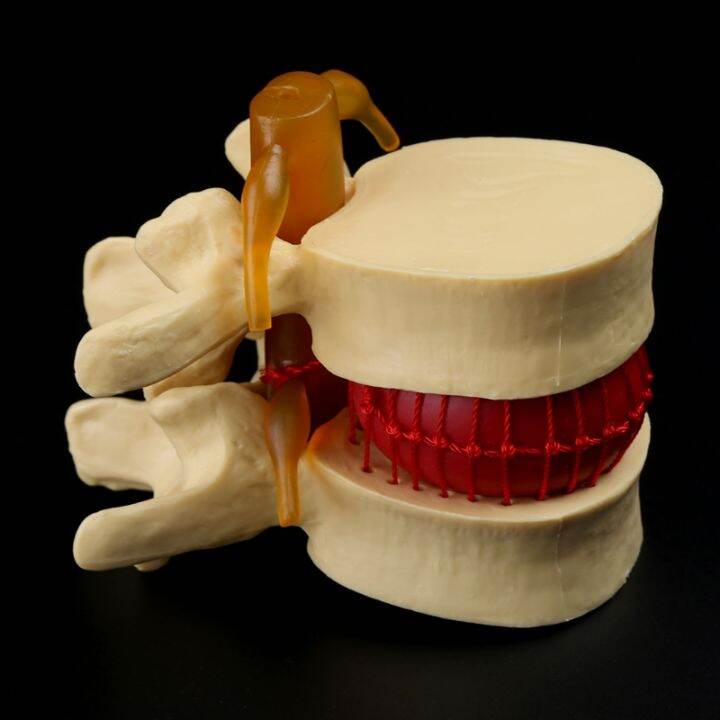 medical-props-model-free-postage-anatomical-spine-lumbar-disc-herniation-anatomy-medical-teaching-tool