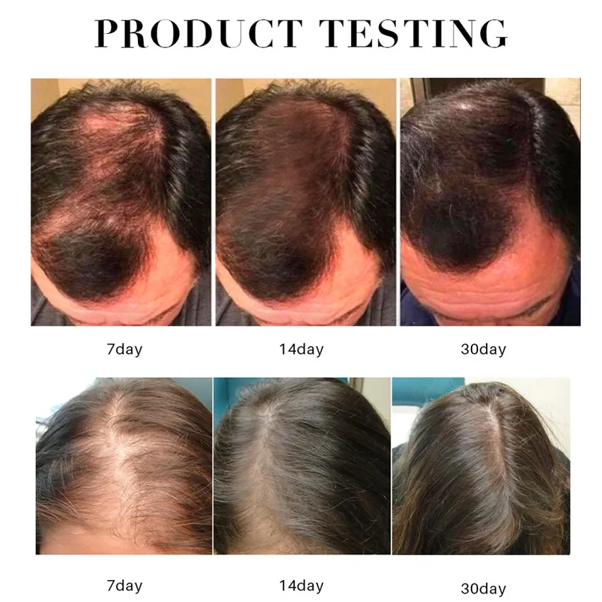 Firstsun Hair Growth Essential Oil Anti Hair Loss Spray For Men Women Dry  Hair Regeneration Repair Hair Loss Products Hair Care|Men's Hair Loss  Products| AliExpress | First Sun Hair Serum 30ml |