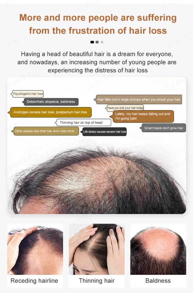 Update 154+ dream about losing hair best POPPY