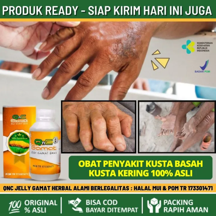 Obat Untuk Penyakit Kusta Herbal, Obat Kusta Basah & Kusta Kering Cocok ...