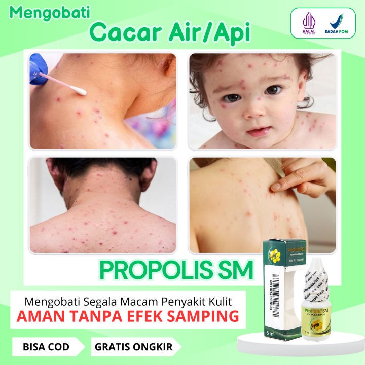 Obat Cacar Air, Obat Cacar Api, Obat Campak Anak Dan Dewasa Alami ...