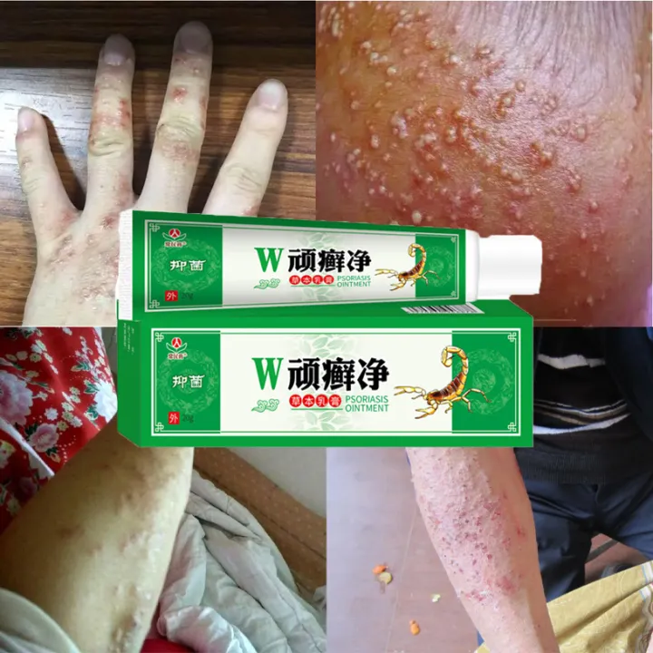 3Pcs Eczema Treatment Cream Antifungal Antibacterial Itchy Cream Psoriasis Antipruritic