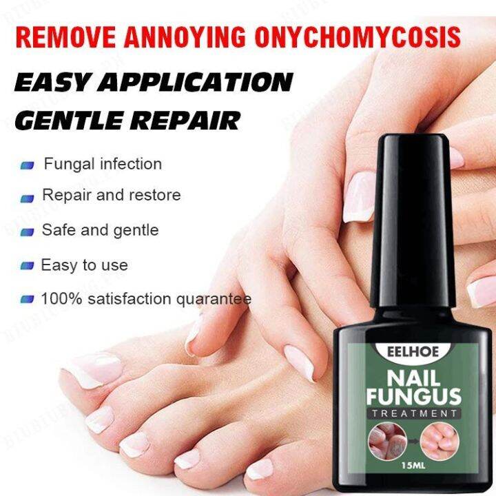 Onychomycosis liquid hand and foot onychomycosis care repair