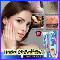 ?Mole Remover Cream Skin tag Remover Mole skin Dark Spot Warts  remover  &amp; แต้ม ไฝ หุดและติ่งเนื้อ ลอก ตาปลา จดด่างดำและสิว 20g เห็นผล เร้ ว เมื่อใช้ต่อเนื่อง