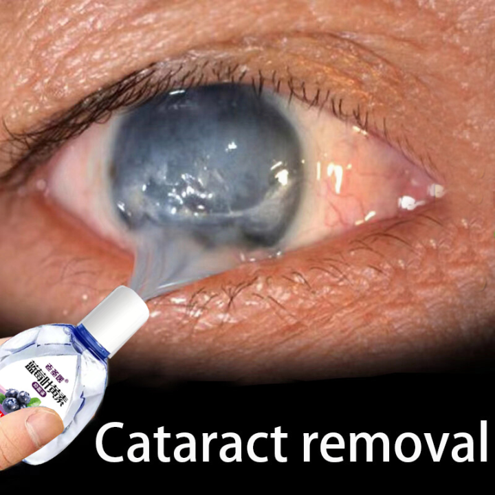Eye drop Cataract Eye Drops Bright Eye Drops, AntiFatware, Blurred