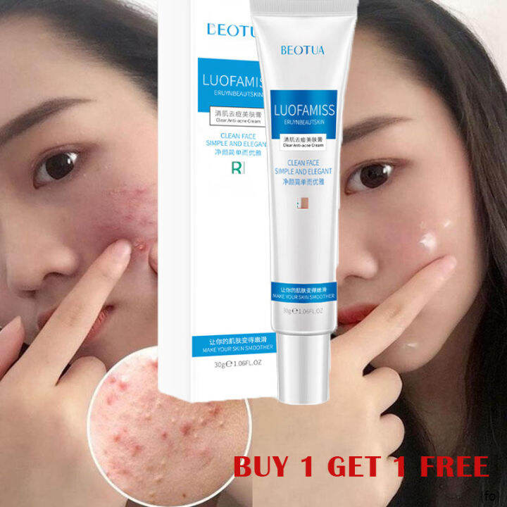 Acne remover cream Pimple eraser Pimple marks remover Pore minimizer