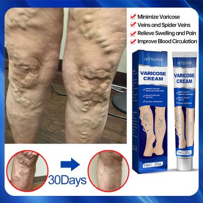 ครีมครีม Relief เส้นเลือดขอดที่เท้าที่มีประสิทธิภาพสำหรับเส้นเลือดขอดที่เท้า S เพื่อบรรเทาการรักษาอาการปวดแมงมุม Vasculitis Phlebitis