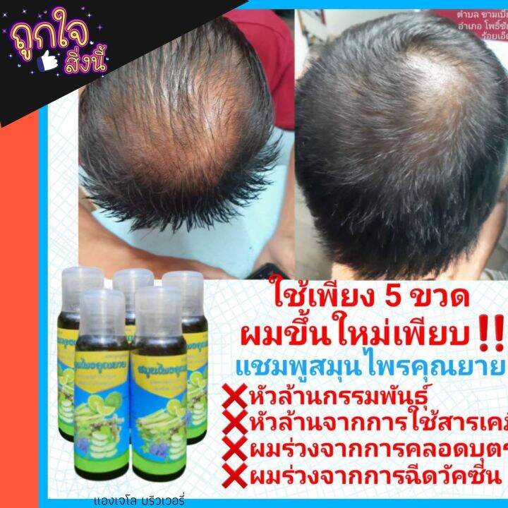 แชมพูแก้หัวล้านจากสมุนไพรไทย-ลดผมร่วง-ผมบาง-เชื้อราหนังศรีษะ-แชมพูสมุนไพรคุณยาย