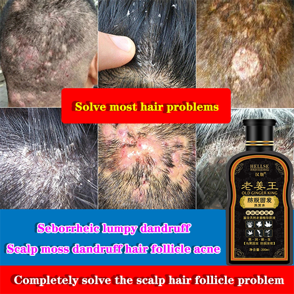 Chinese herbal shampoo treats scalp dandruff head tinea capitis scalp  ringworm folliculitis 200ml Effectively prevent hair loss and regain  healthy hair growth | Lazada