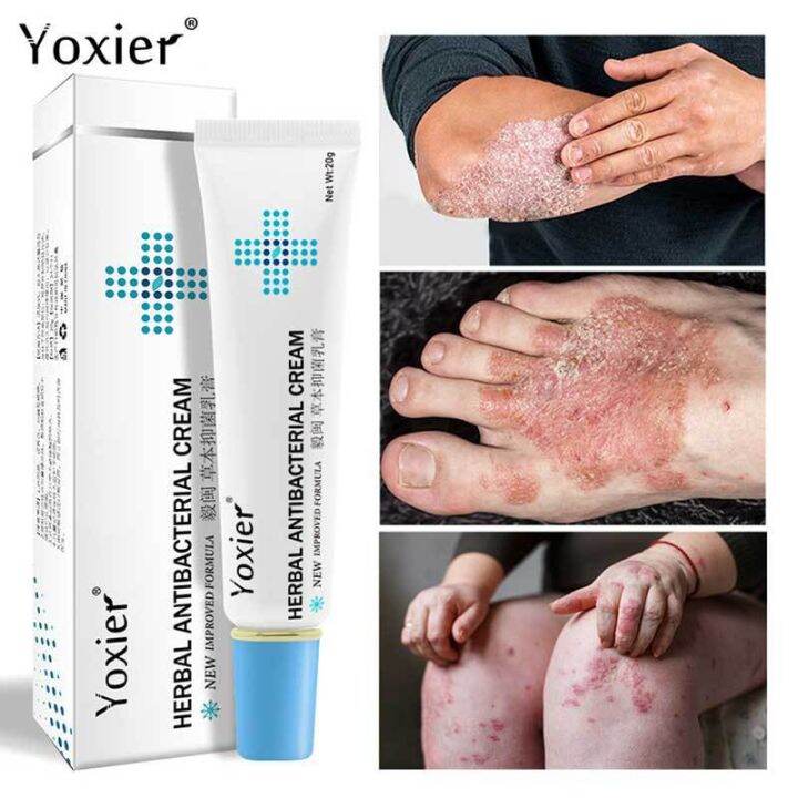 Factory Direct Sales Yoxier Herbal Antibacterial Cream Eczema Cream