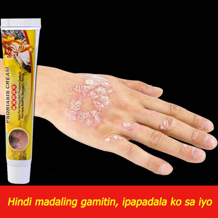 tanggihan ang pangangati Sumifun Psoriasis Treatment Ointment solve the ...