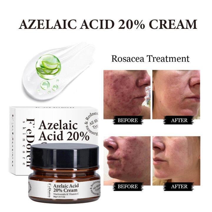 Azelaic Acid 20 Whitening Fades Acne Cream Freckle Remove Melasma Dark Pigment Spots Melanin Azelaic Acid 20 Whitening Fades Acne Cream Freckle Remove Melasma Dark Pigment Spots Melanin