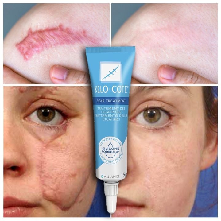 KElO·COTE Scar Removal Cream repair stretch mark remover gel Scars