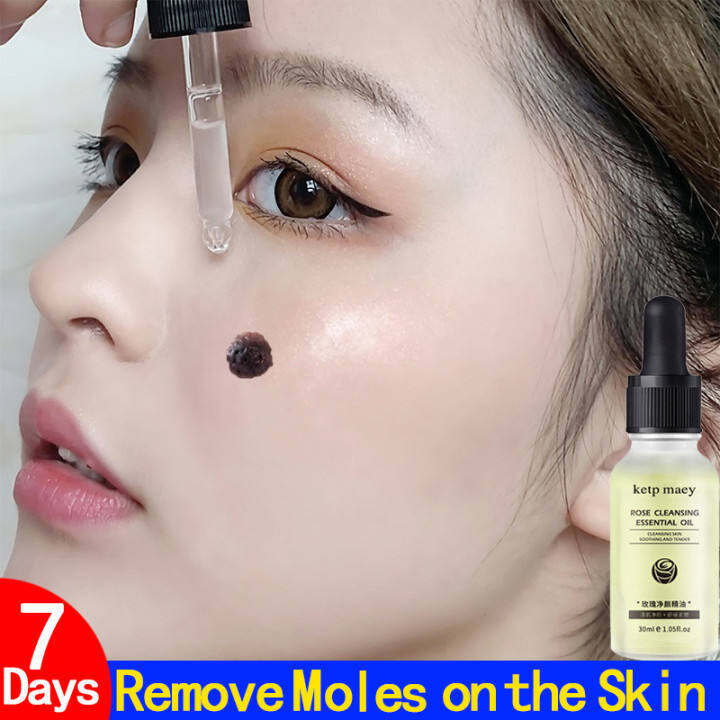 Mole Warts Remover Serum Warts Removal Liquid Ointment Warts Remover Original Cream Effectively 8139