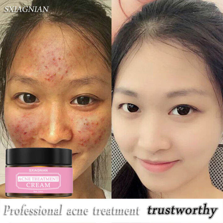 SXIAGNIAN Acne Cream, effective in removing acne marks, diminishing