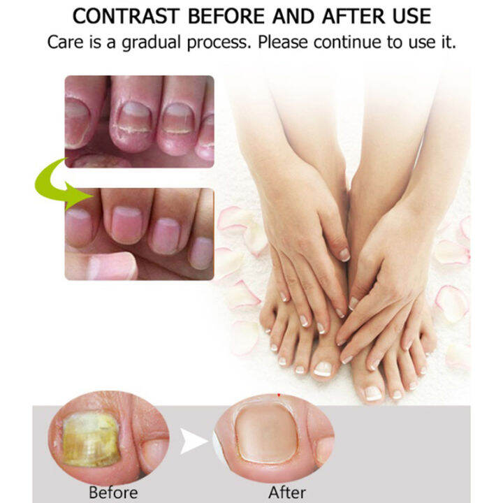 belle-1ชิ้นป้องกันเชื้อราเล็บรักษาครีม-onychomycosis-nail-infection-feet-care