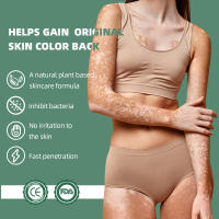 Vitiligo Treatment Ointment with Fragrance Fast Results Herbal Material Universal for All Skins