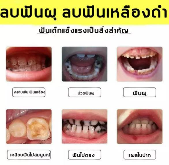 ลดฟันเหลือง-ป้องกันฟันผุ-ยาสีฟันน้ำผึ้งธรรมชาติ-bangchiling-ลดหินปูน-คราบฟัน-ปวดฟัน-มูสฟอกฟันขาว-ยาสีฟันน้ำผึ้ง-ยาสีฟันฟอกขา-ยาสีฟัน-ยาสีฟันขจัดปูน-ฟันผุ-ยาสีฟันฟันขาว-ปวดฟันผุ-ฟันขาว-น้ำยาขัดฟันขาว-ย