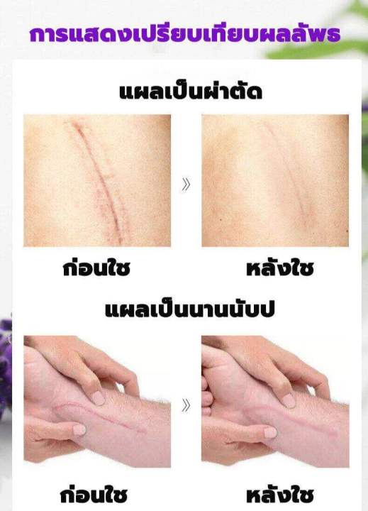 รอยแผลเป็นอำลา-ครีมลดรอยแผลเป็น-ซ่อมแซมแผลเป็น-แผลเป็นผ่าตัด-แผลไฟไหม้-น้ำร้อนลวก-แผลเป็นนูนหนา-แผลเป็นถลอก-เร่งการซ่อมแซมให้ผิว-เจลลบรอยแผลเป็น-ครีมทาแผลเป็น-ครีมแผลเป็น-เจลซ่อมแซม-เจลรอยแผลเป็น-รอยแ