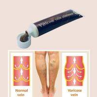 【SALE】 glisutgechil1974 การรักษาหลอดเลือดดำโป่งขดแมงมุม Vasculitis Phlebitis เส้นเลือดขอดแก้ปวด Varicosity Angiitis