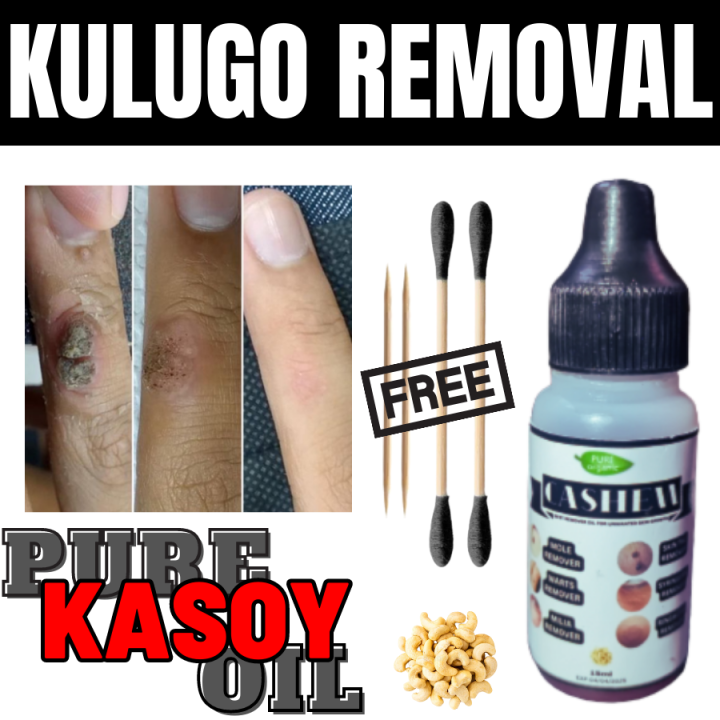 KULUGO REMOVAL CASHEW OIL , kulugo remover original , kulugo remover ...