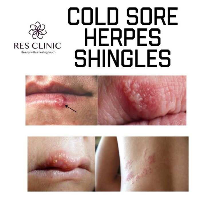 promo! [RES CLINIC] Cold Sore Herpes Shingles Healing Medicated ...