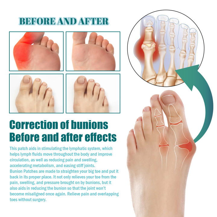 eelhoe-แผ่นแปะบรรเทาอาการเจ็บปวมนิ้วแบบนุ่มเท้ากระดูกตัวปรับนิ้วหัวแม่มือ-hallux-valgus-bunion-แก้ไขความเครียดที่ยืดแผ่นรองรองเท้าได้-6ชิ้น-กล่อง
